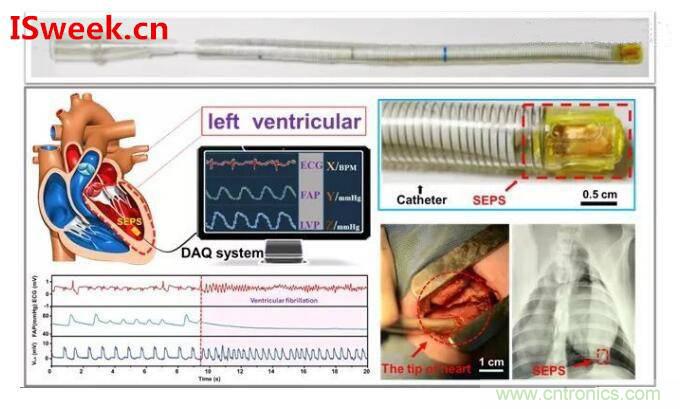 詳解光纖壓力傳感器在心內(nèi)壓評估的應用 詳解光纖壓力傳感器在心內(nèi)壓評估的應用